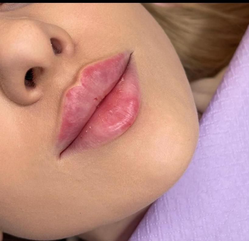 تزریق فیلر بوتاکس390 لیزر زاویه متدmd codeمزوپزشک|خدمات آرایشگری و زیبایی|تهران, طرشت|دیوار