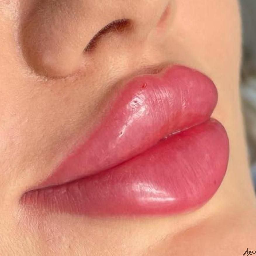 تزریق ژل لب روسی بوتاکس چشم گربه ای فیلرزیرچشم|خدمات آرایشگری و زیبایی|تهران, ستارخان|دیوار