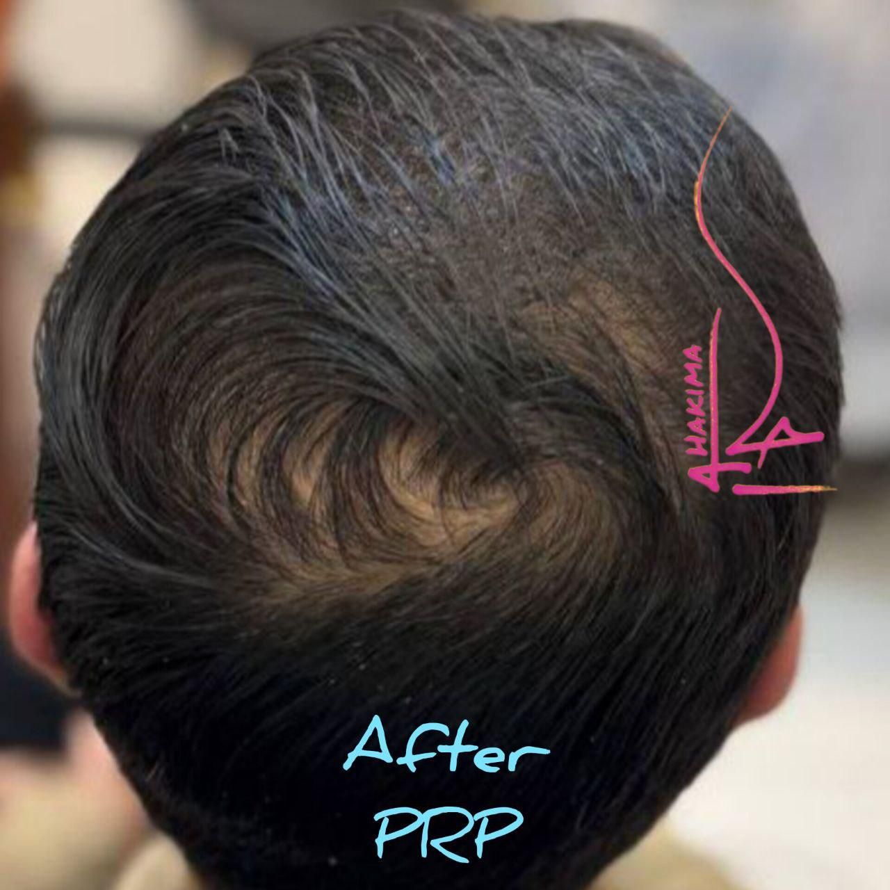 پی ار پی PRP ،مزوتراپی،اگزوزوم ولنجک،زعفرانیه|خدمات آرایشگری و زیبایی|تهران, محمودیه|دیوار