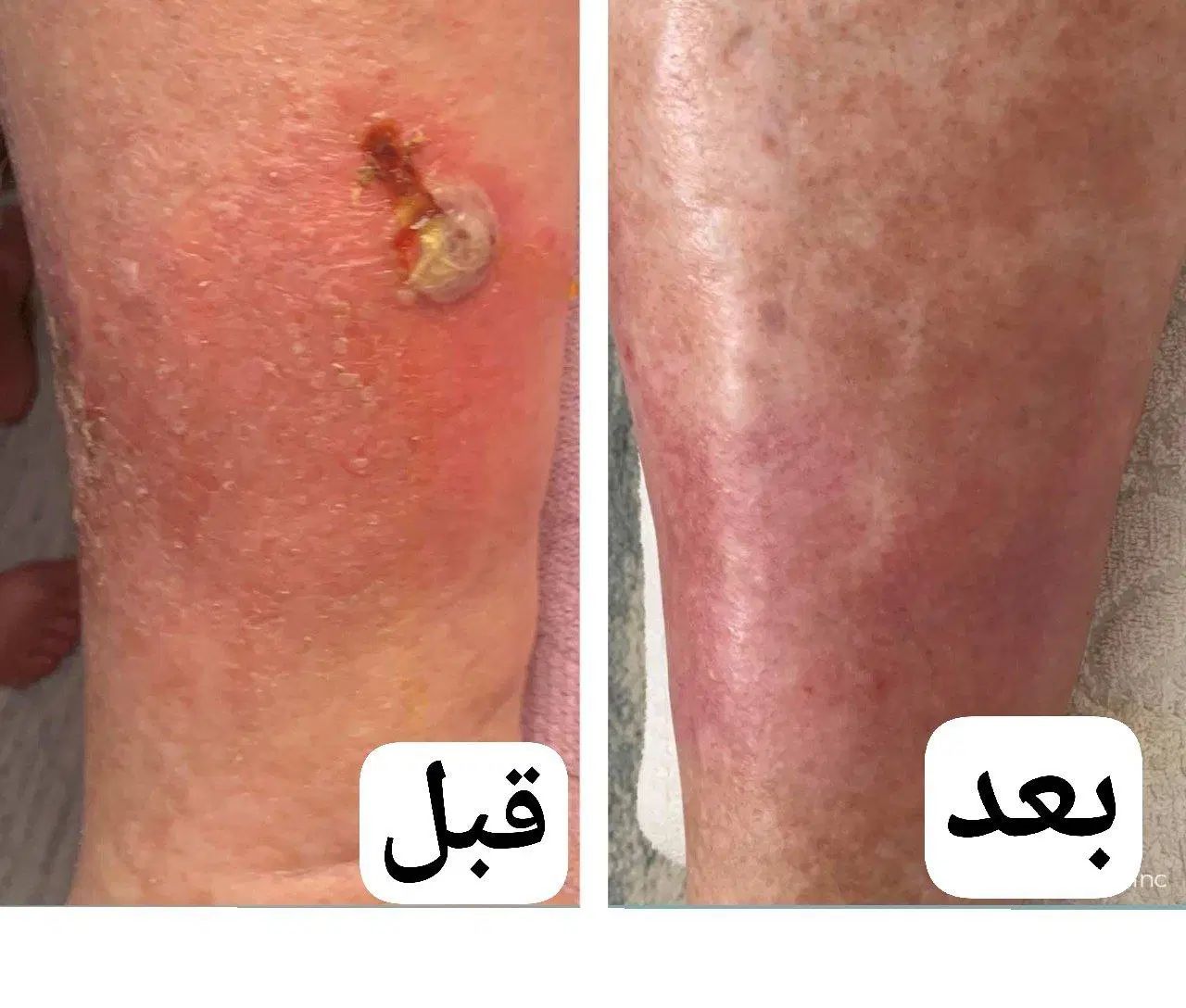 درمان قطعی زخم بستر و زخم دیابتی و زخم های مزمن|خدمات آرایشگری و زیبایی|تهران, هروی|دیوار