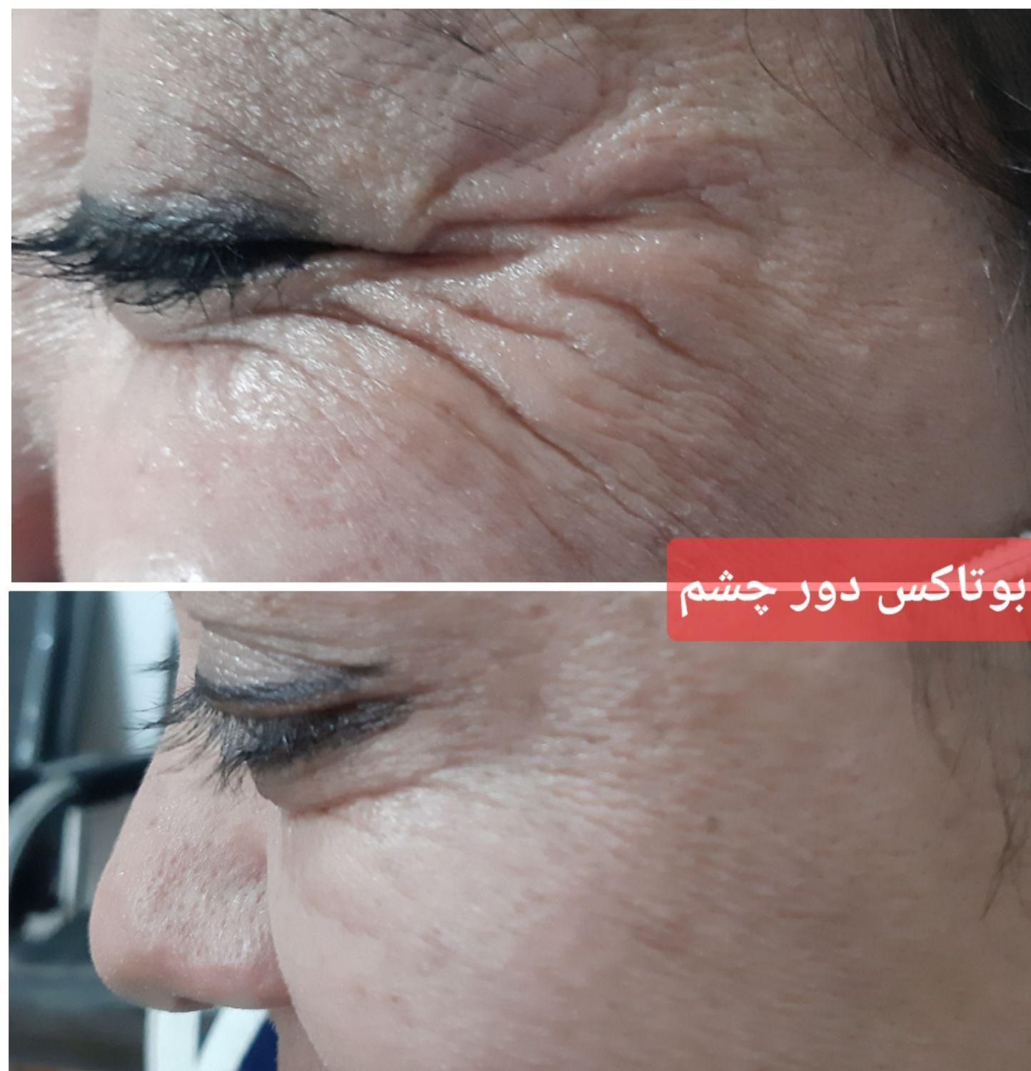 لیزر بوتاکس ژل خالبرداری|خدمات آرایشگری و زیبایی|سیرجان, |دیوار