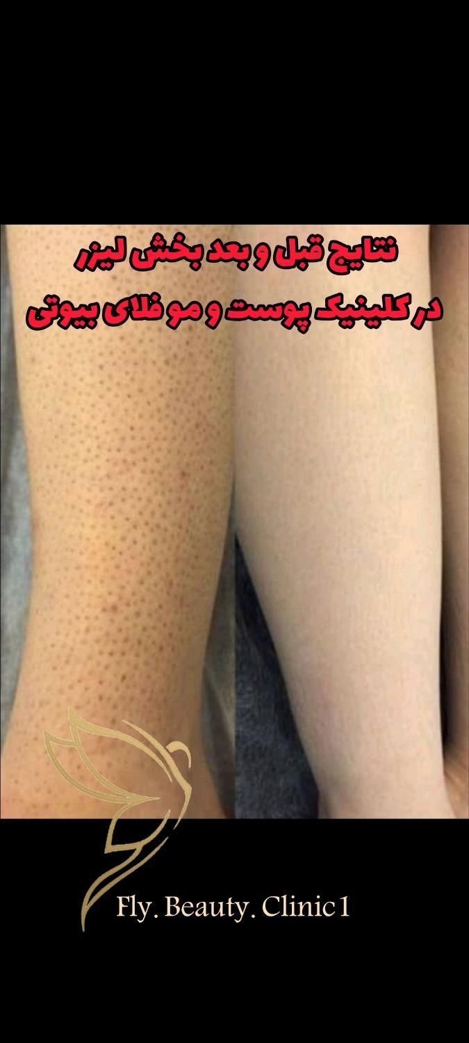 لیزر موهای زاید روشن سازی پاک کردن تتو دردرمانگاه|خدمات آرایشگری و زیبایی|شیراز, حافظیه|دیوار