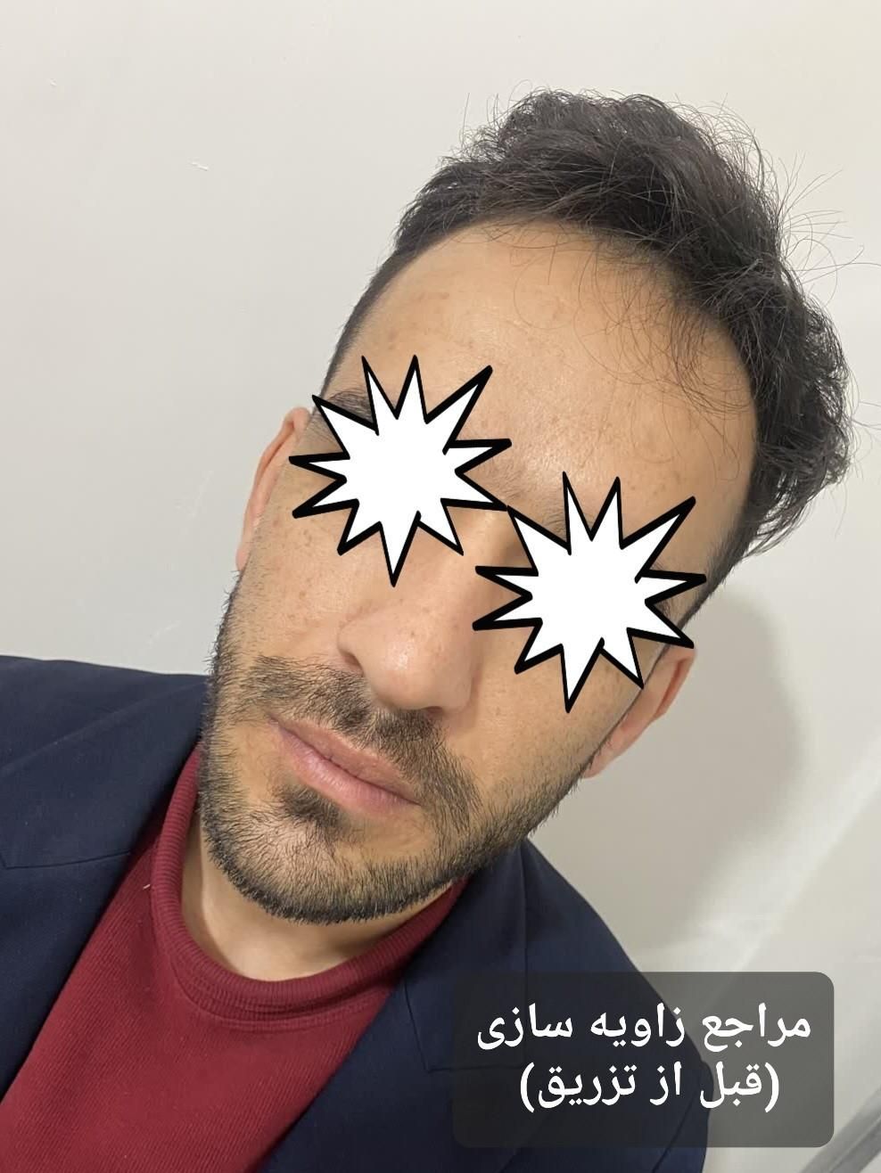 ژل وبوتاکس بلک فرایدی404(اقساط)(توسط پزشک)|خدمات آرایشگری و زیبایی|خرمآباد, |دیوار