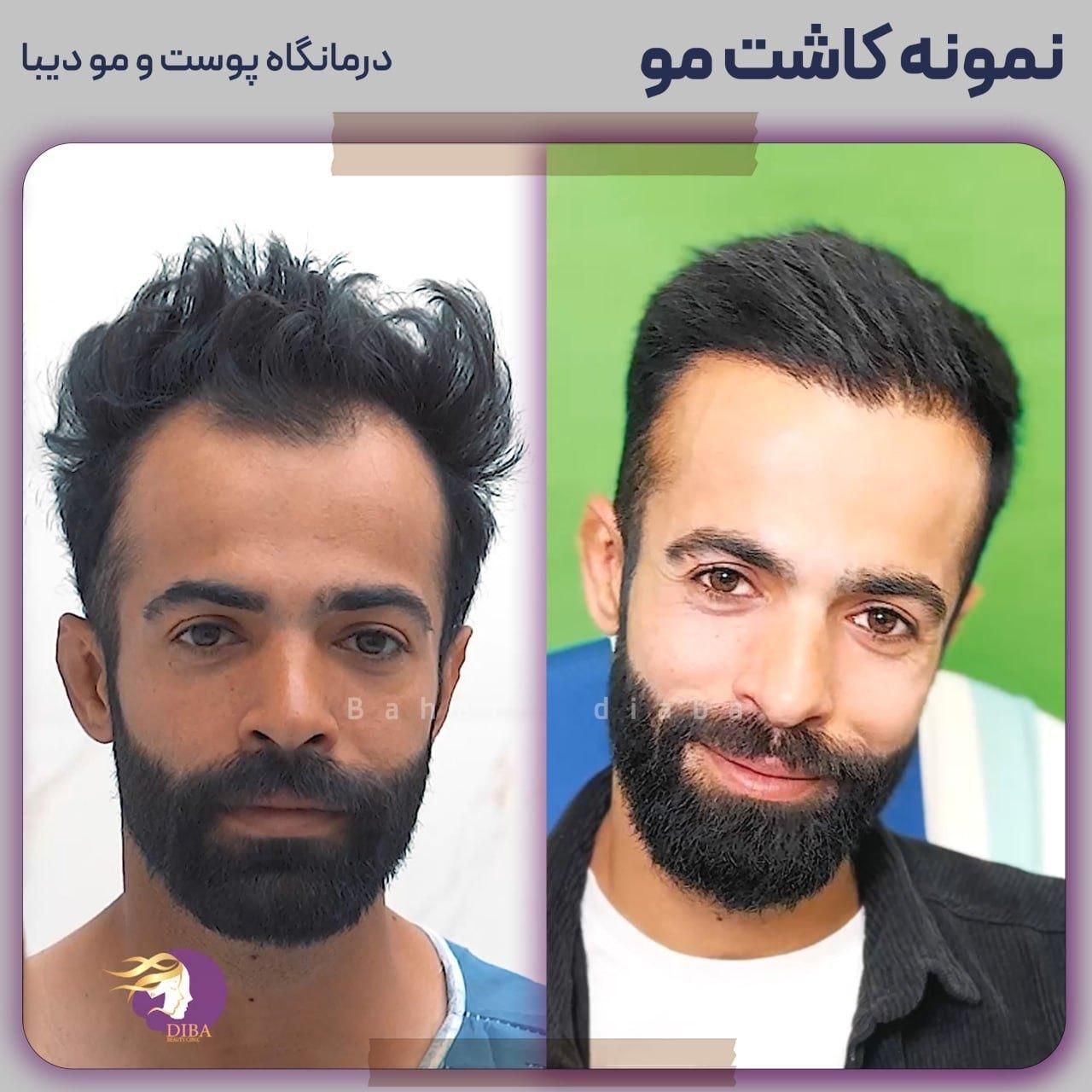 (+فیلم) کلینیک کاشت مو، ابرو و ریش|خدمات آرایشگری و زیبایی|تهران, صادقیه|دیوار