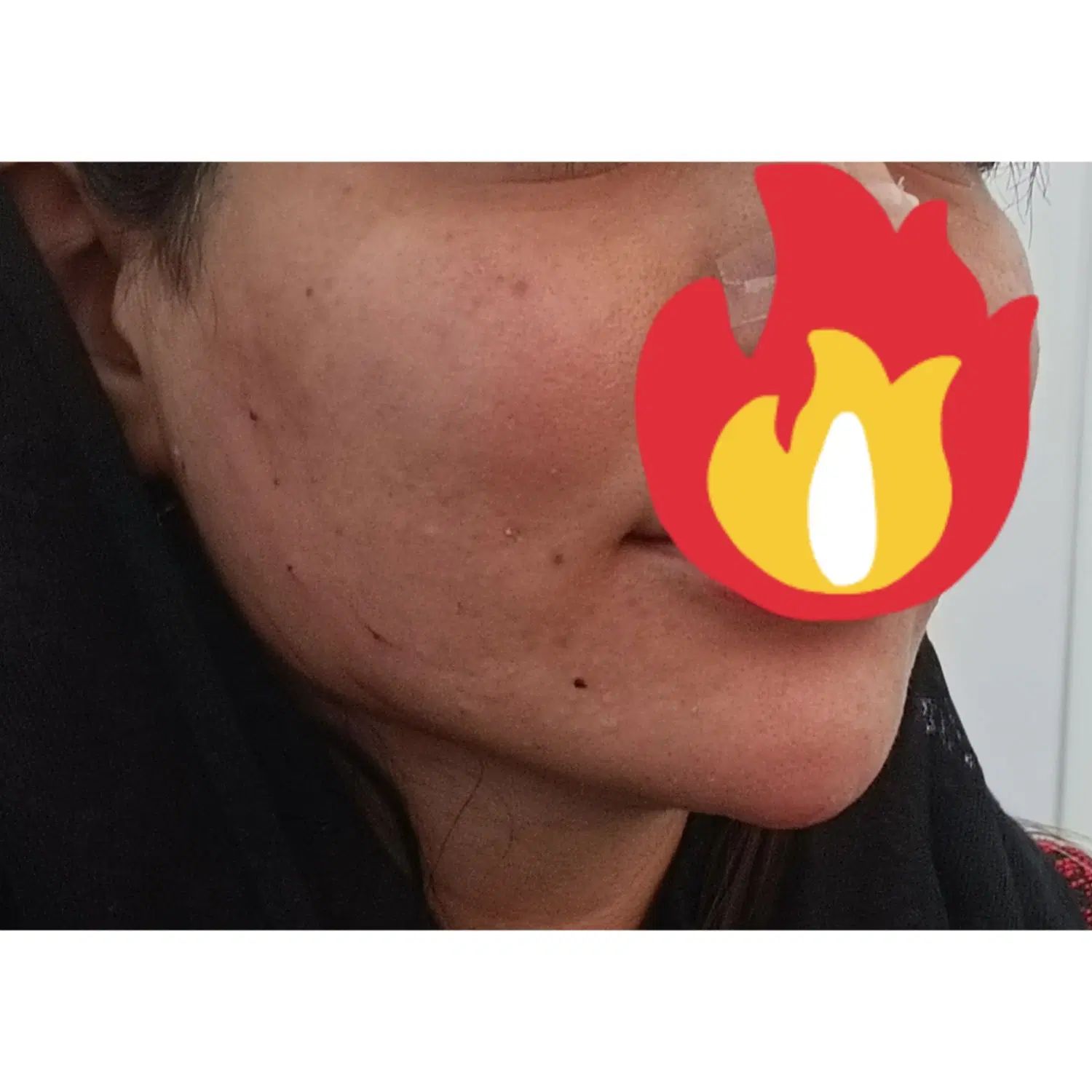 ژل افف 580نزیم بینی میکرونیدلینگ باسابقه شش سال|خدمات آرایشگری و زیبایی|یاسوج, |دیوار