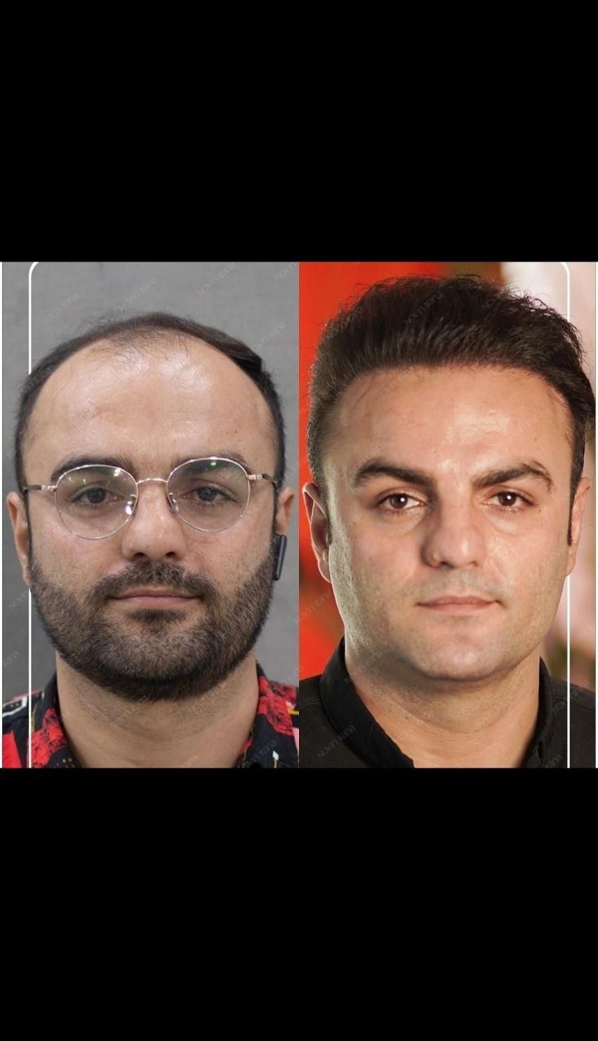 کاشت مو و ابرو در میانه|خدمات آرایشگری و زیبایی|میانه, |دیوار