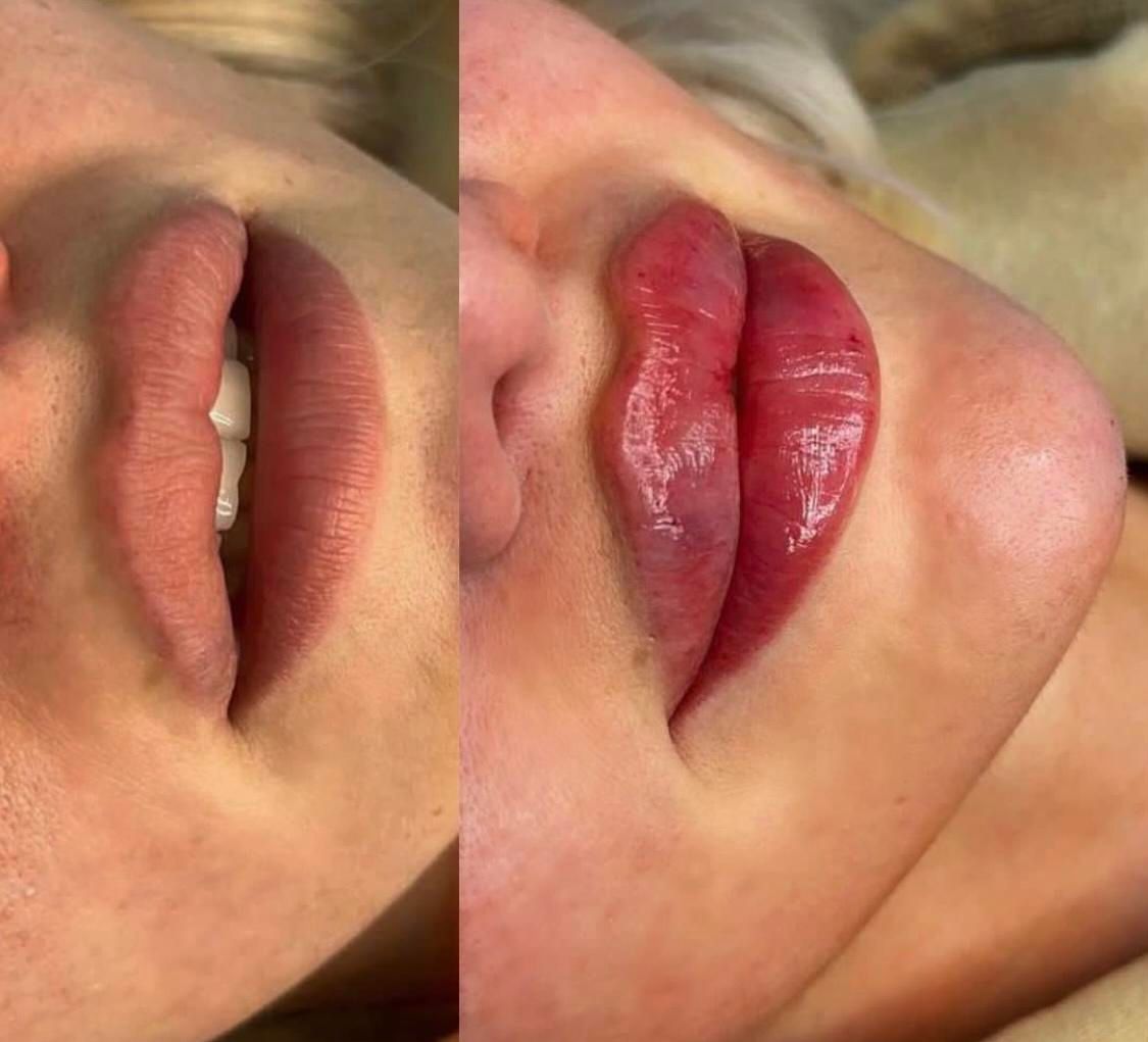 کلینیک تزریق ژل لب روسیm مادلینگ mdبوتاکس لیزر|خدمات آرایشگری و زیبایی|تهران, صادقیه|دیوار