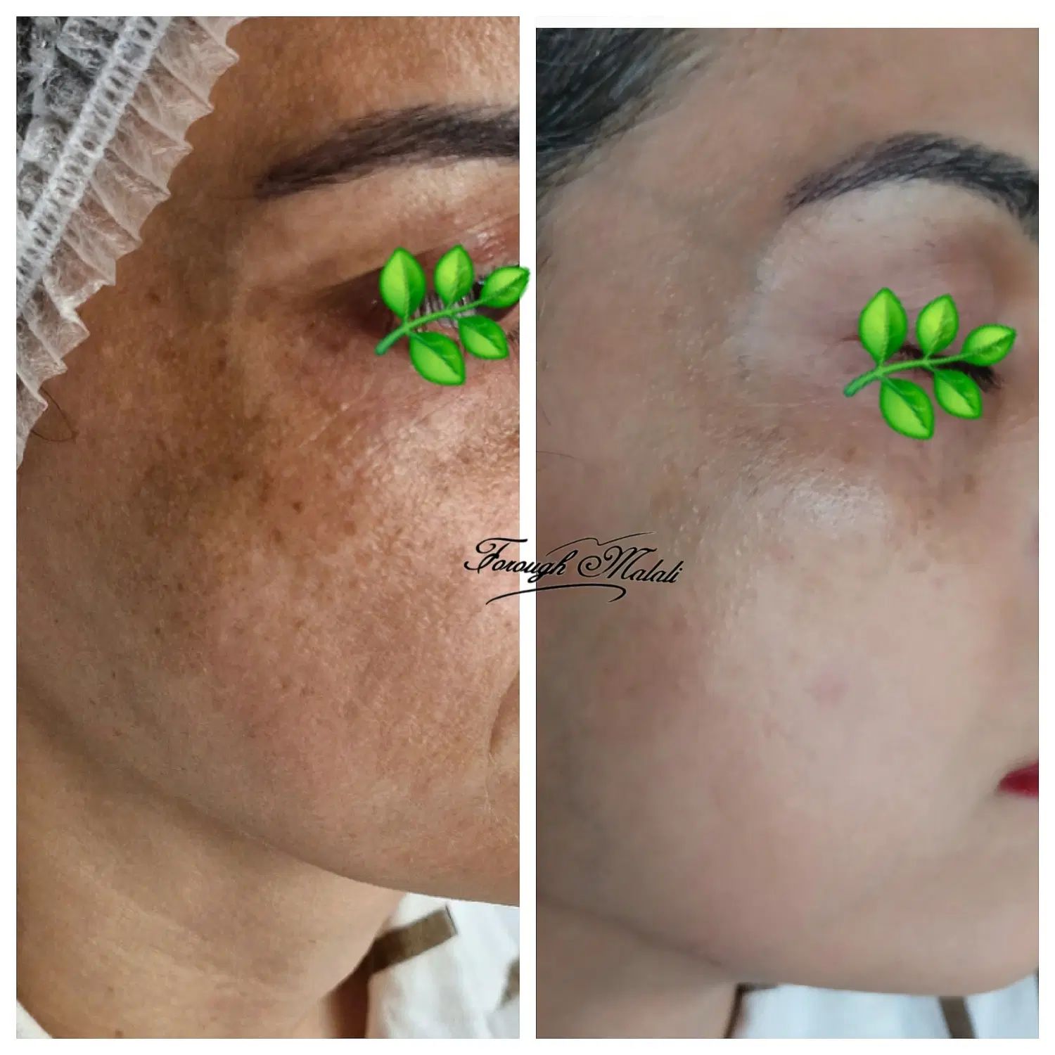 حذف تک جلسه ای لک و کک مک کلینیک|خدمات آرایشگری و زیبایی|رشت, گلسار|دیوار