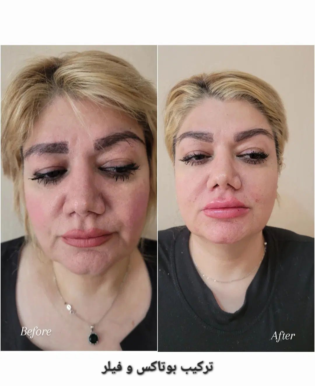 خدمات و آموزش تخصصی ژل و بوتاکس|خدمات آرایشگری و زیبایی|کرج, کیانمهر|دیوار