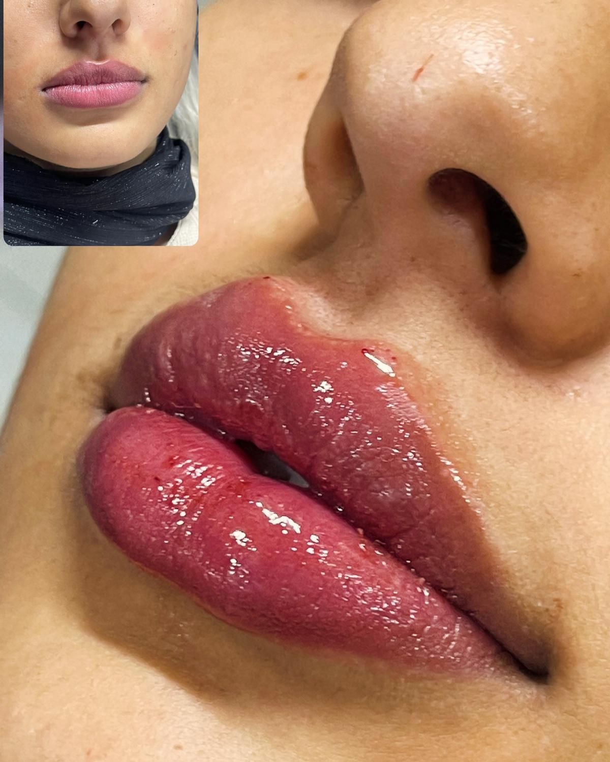 ژل لب تزریق ژل بوتاکس ژل گونه چانه زاویه فک|خدمات آرایشگری و زیبایی|اصفهان, سعادت‌آباد|دیوار