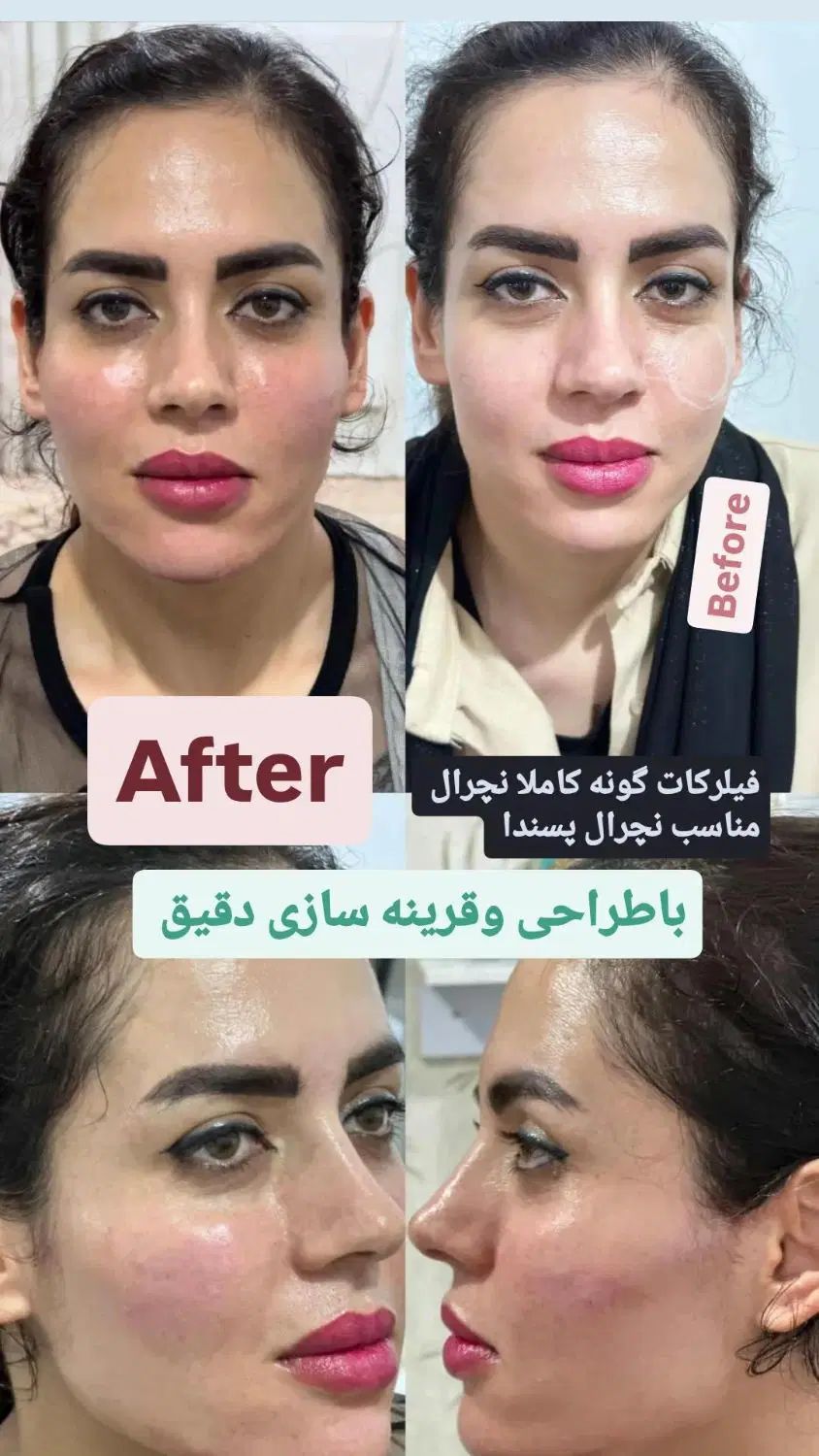 آموزش وتزریق،ژل،بوتاکس،مزوژل زیرچشم،آنزیم ومزو|خدمات آرایشگری و زیبایی|کرج, فاز ۳ گوهردشت|دیوار