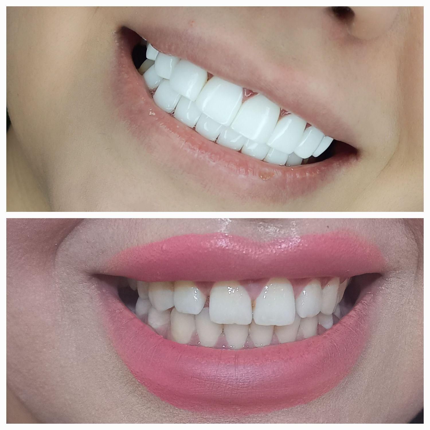 کامپوزیت دندان (( طرح لبخند ))|خدمات آرایشگری و زیبایی|یاسوج, |دیوار