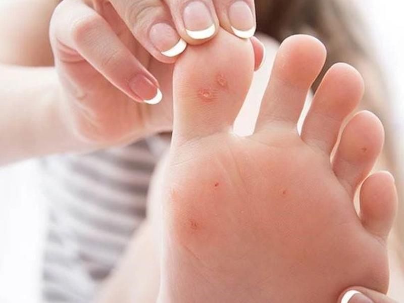 زگیل خال گوشتی و مخچه و...|خدمات آرایشگری و زیبایی|سرپل ذهاب, |دیوار