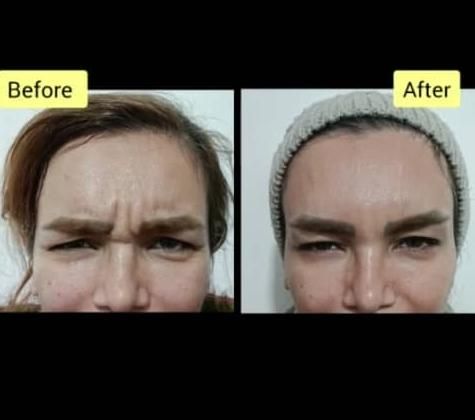 تزریق بوتاکس صورت تعریق میگرن لبخند لثه ای|خدمات آرایشگری و زیبایی|صدرا-فارس, |دیوار