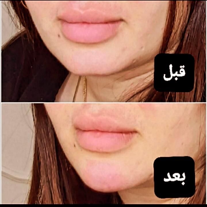 نیازمند مدل بوتاکس و ژل.اموزش ژل و بوتاکس|خدمات آرایشگری و زیبایی|صدرا-فارس, فاز ۱|دیوار