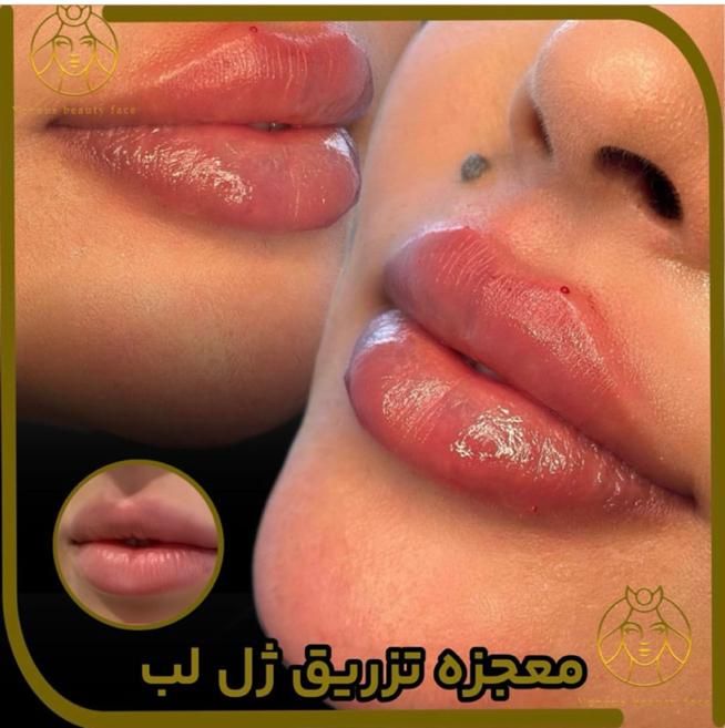 جشنواره کلینیک تزریق ژل لب متدM لیزر390بوتاکس|خدمات آرایشگری و زیبایی|تهران, سعادت‌آباد|دیوار