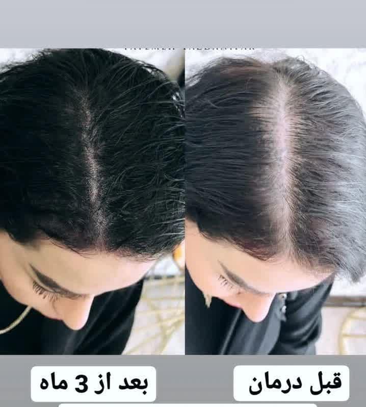 پک گیاهی ضد ریزش و رویش مجدد مو|آرایشی، بهداشتی، درمانی|شیراز, درکی|دیوار