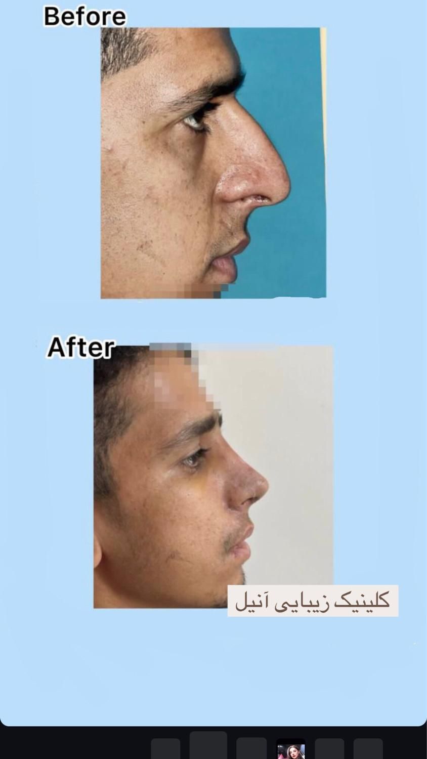 عمل بینی بندرعباس،اقساطی،باکیفیت و تضمین|خدمات آرایشگری و زیبایی|بندرعباس, |دیوار