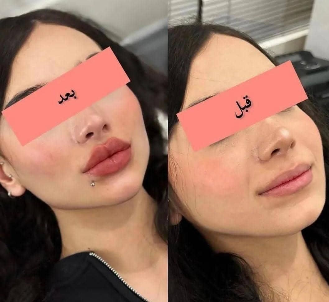 جشنواره مدلینگ ۱۰ سی سی امروز۳۳۰۰فیلر لب لیفت ابرو|خدمات آرایشگری و زیبایی|تهران, مرزداران|دیوار