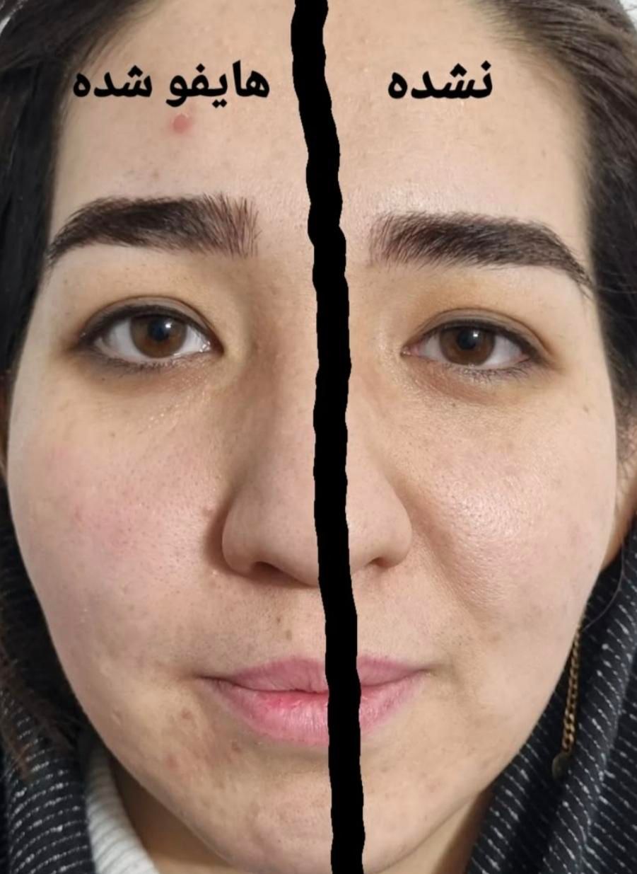 جشنواره هایفوتراپی vip همراه فیشال اشانتیون|خدمات آرایشگری و زیبایی|رشت, رودباری|دیوار