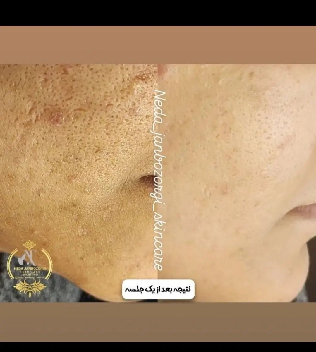 فیشال و پاکسازی پوست زیر نظر متخصص پوست|خدمات آرایشگری و زیبایی|رشت, بوسار|دیوار
