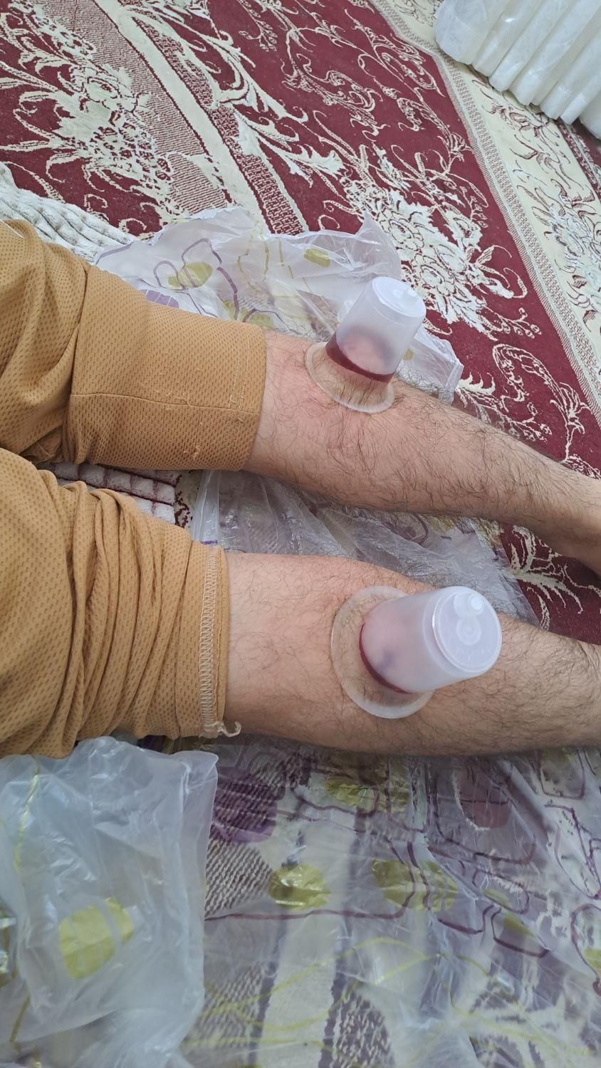 دمنوش کلیه حجامت بادکش|آرایشی، بهداشتی، درمانی|کازرون, |دیوار