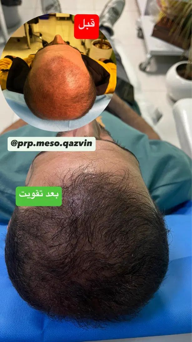 پی آر پی مو و صورت تخفیف ویژه پی ارپی بعدازکاشت مو|خدمات آرایشگری و زیبایی|قزوین, |دیوار