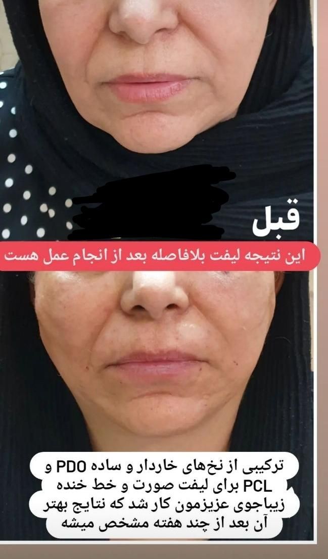 مدل لاغری بدون دستگاه و بدون عوارض‌|استخدام درمانی، زیبایی، بهداشتی|شیراز, قدوسی غربی|دیوار