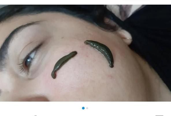 حجامت عام وکبد بادکش گرم زالودرمانی فصدخون امبدینگ|خدمات آرایشگری و زیبایی|اصفهان, ملک‌شهر|دیوار