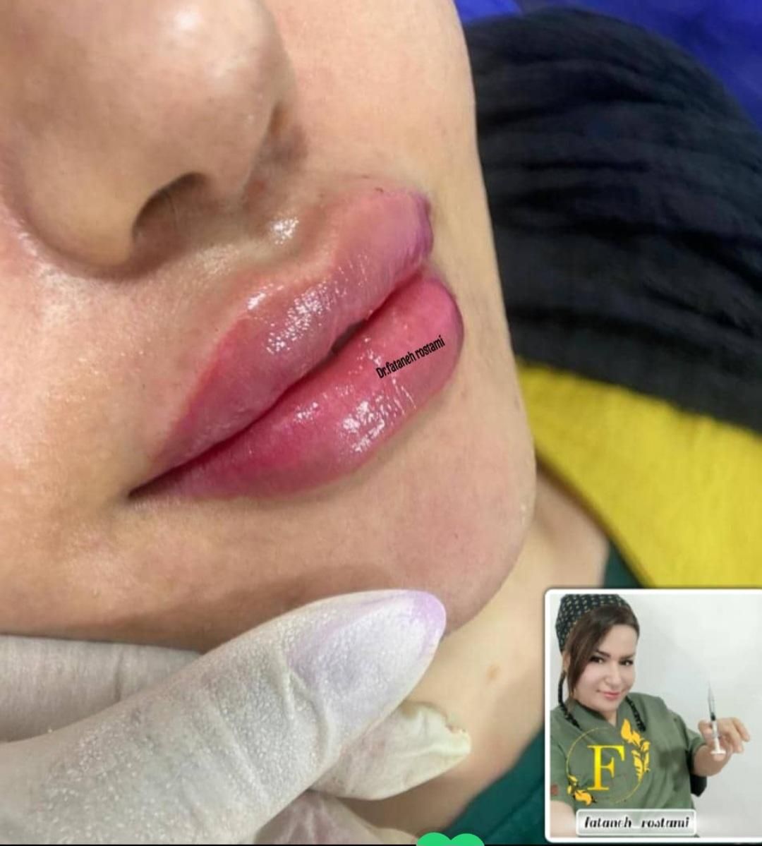 تزریق ژل و بوتاکس و آموزش حرفه ای|خدمات آرایشگری و زیبایی|اهواز, سپیدار|دیوار