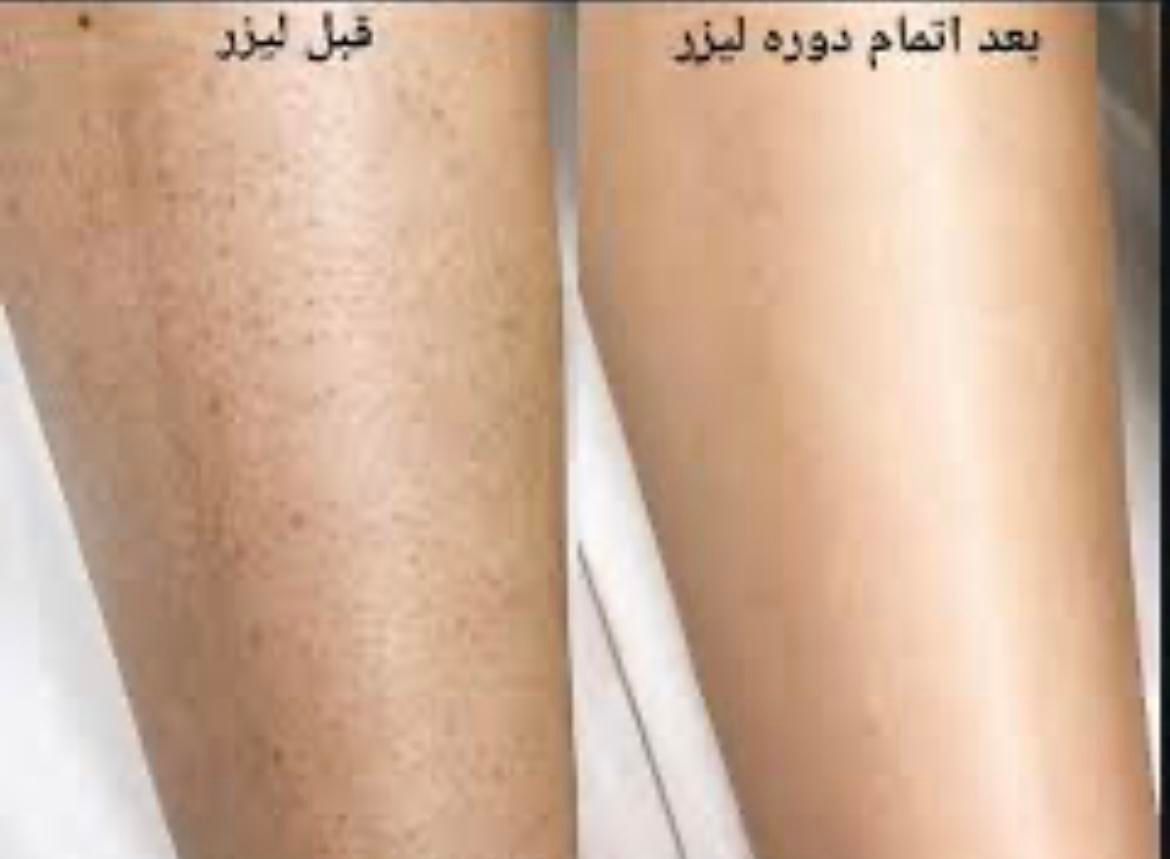 لیزر موهای زائد/ریمو تتو/لاغری/ژل/بوتاکس|خدمات آرایشگری و زیبایی|تهران, سعادت‌آباد|دیوار