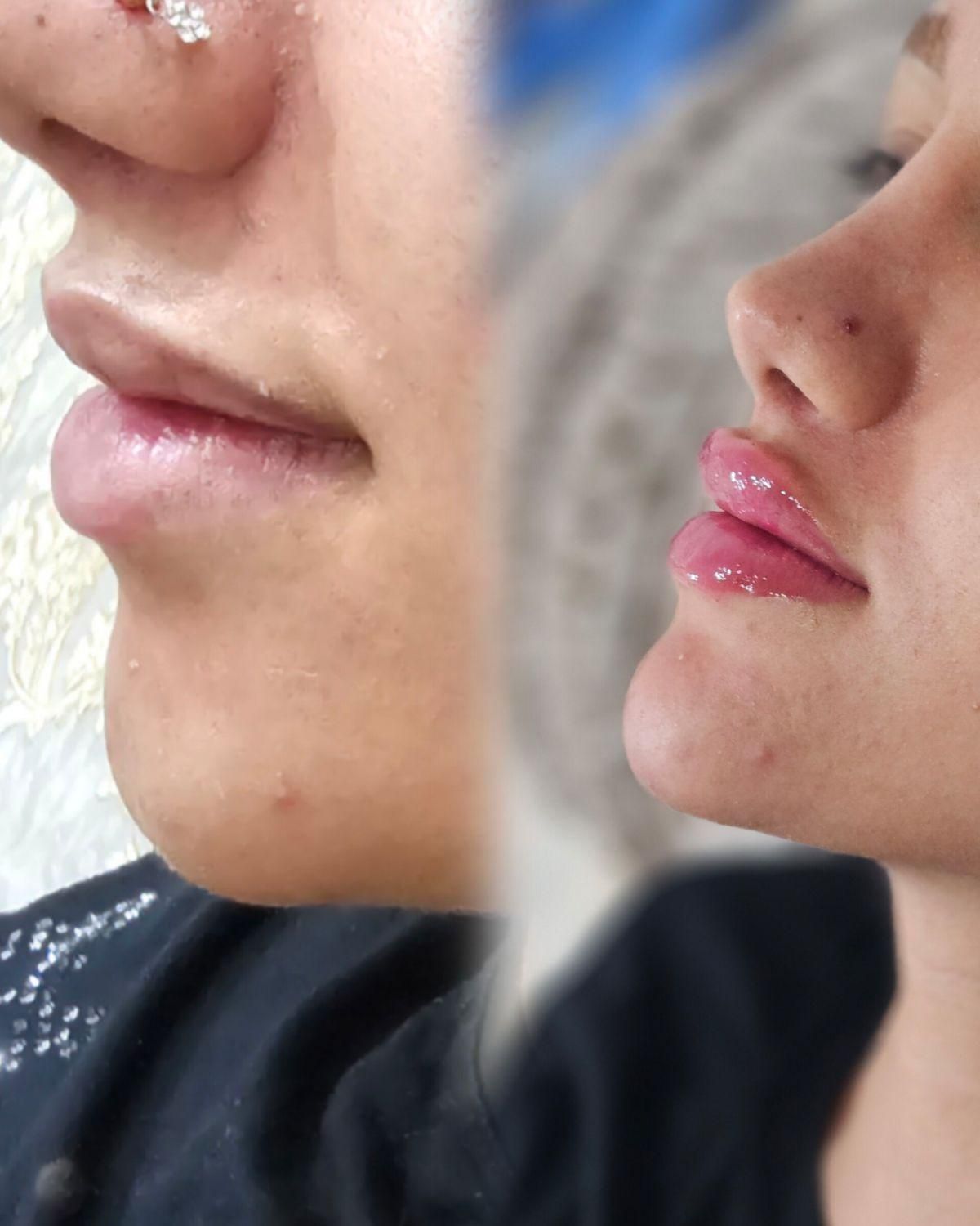 تزریق ژل و بوتاکس با تخفیف ویژه بهاری*|خدمات آرایشگری و زیبایی|جوانرود, |دیوار