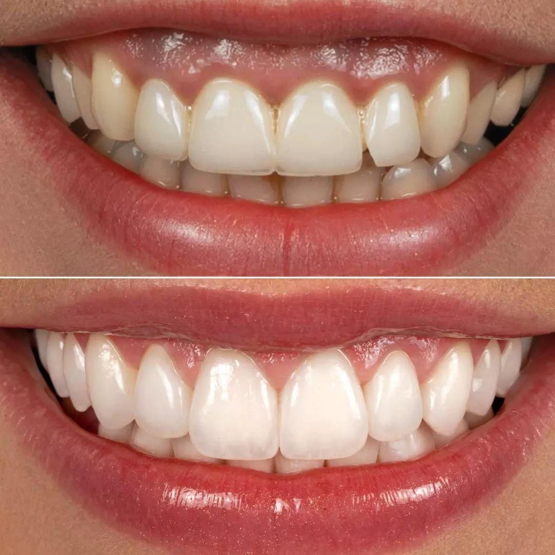 دندانپزشکی ونیر کامپوزیت و لمینت با شرایط پرداخت|خدمات آرایشگری و زیبایی|اصفهان, احمدآباد|دیوار