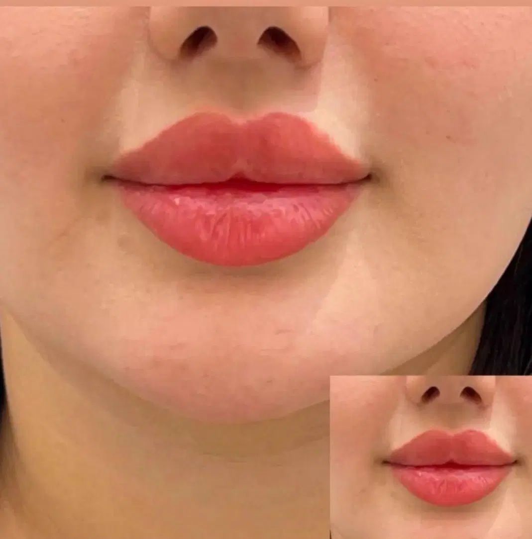 تزریق چربی،ژل،بوتاکس ونخ و مادلینگ تخصصی توسط پزشک|خدمات آرایشگری و زیبایی|کرمانشاه, |دیوار