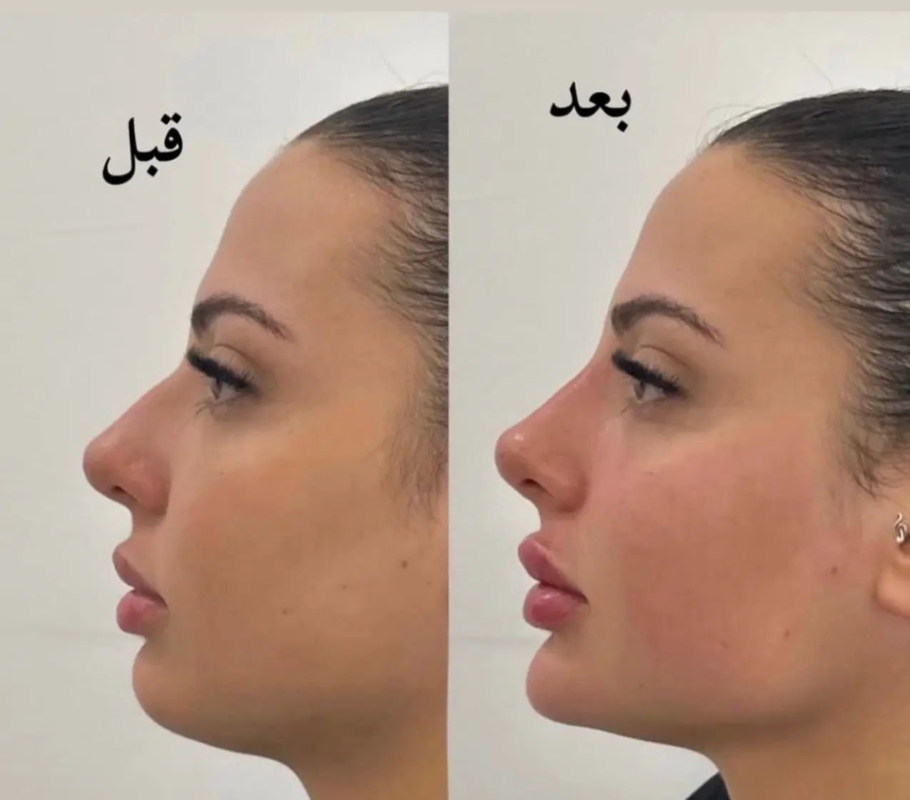 تزریق ژل بوتاکس ساکشن غبغب نخ لیفت توسط پزشک|خدمات آرایشگری و زیبایی|کرج, گلشهر|دیوار