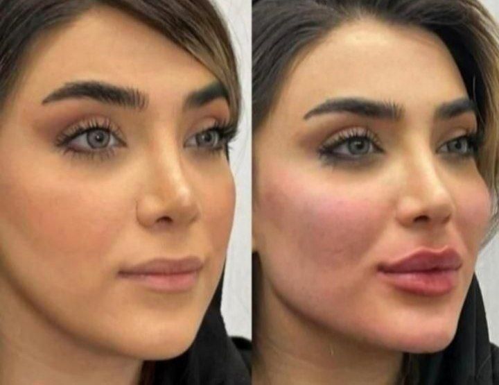 ژل بوتاکس فیلر چشم زاویه فک گونه چانه فشیال بیکینی|خدمات آرایشگری و زیبایی|قم, زنبیل آباد|دیوار