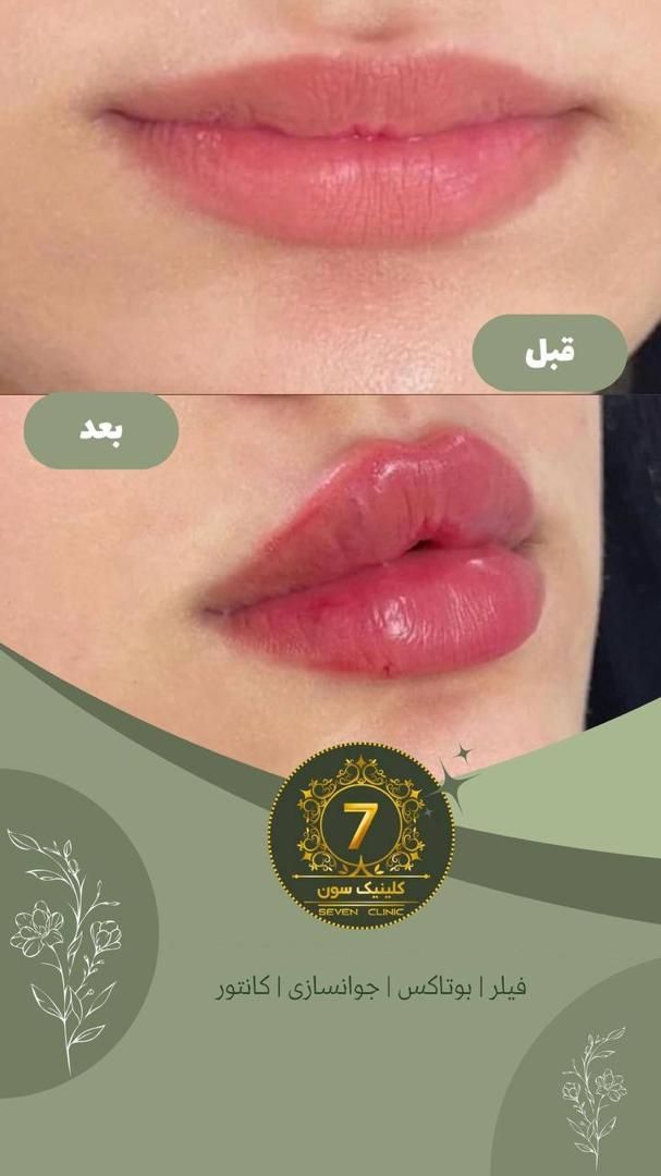 تخفیفات ۴۰ درصدی دکتر کاظمی ژل و بوتاکس فیلر مزو|خدمات آرایشگری و زیبایی|مشهد, کوثر|دیوار