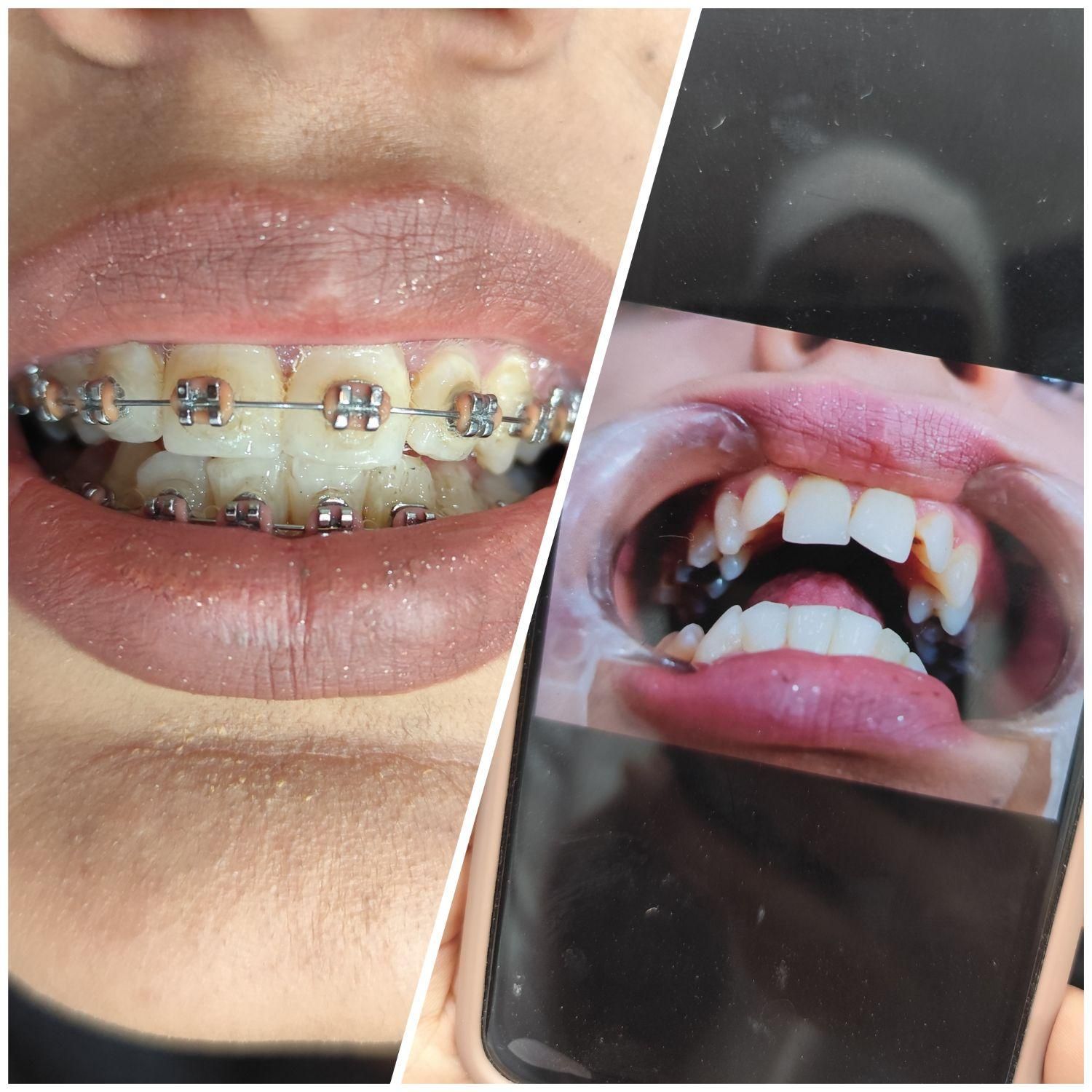 ارتودنسی لبخندی زیبا(فقط تا آخر ماه)|خدمات آرایشگری و زیبایی|مشهد, آزادشهر|دیوار