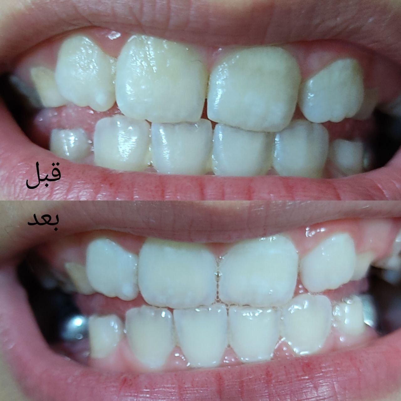 جرمگیر دندان|حراج|اصفهان, شهریار|دیوار