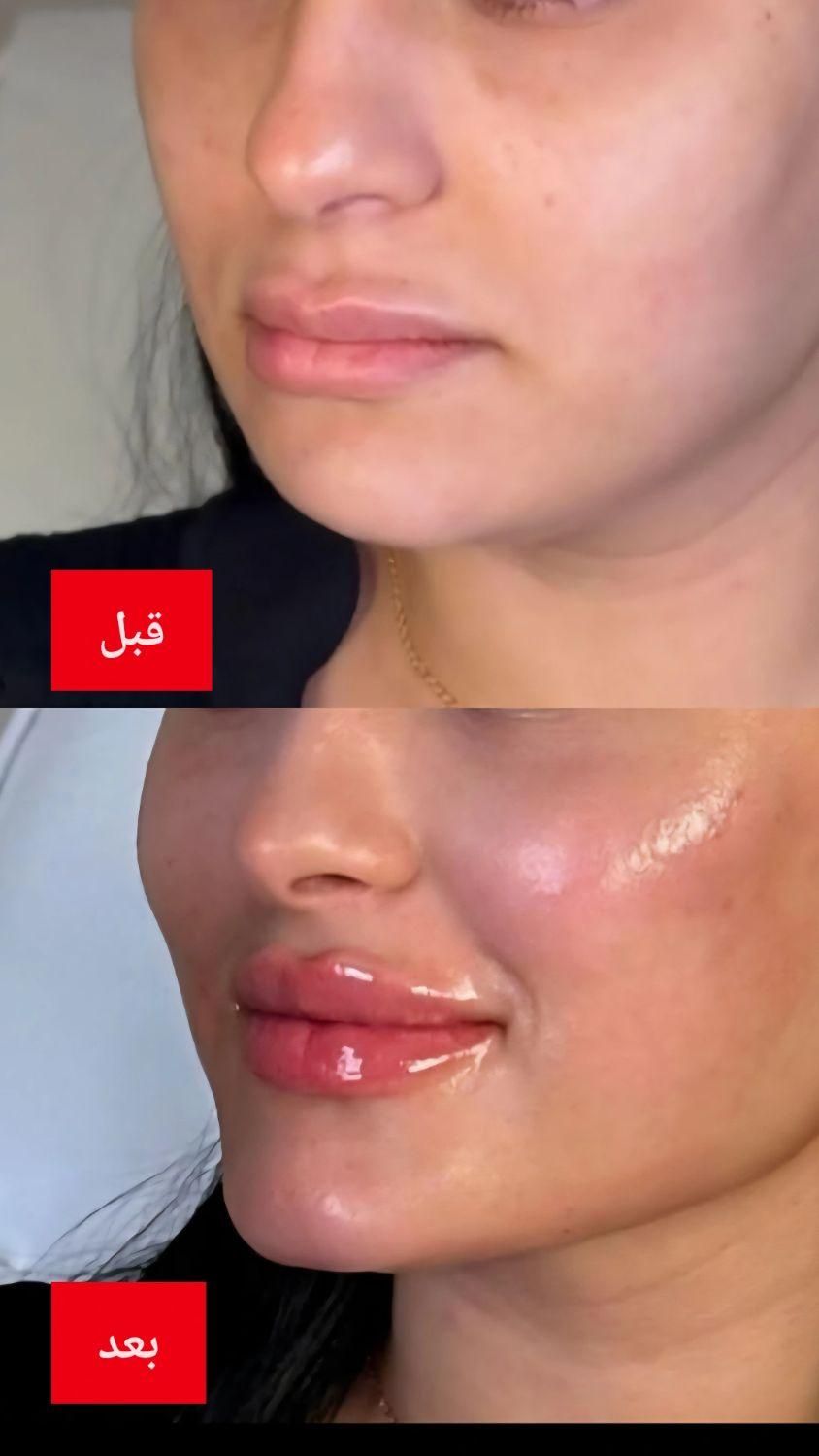 هایفو7 بعدی کل صورت999 هزارتومن|خدمات آرایشگری و زیبایی|اهواز, نادری|دیوار