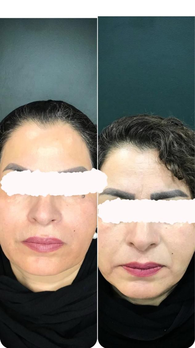 انجام بوتاکس فیلر ژل مزو    اقساط بدون پیش پرداخت|خدمات آرایشگری و زیبایی|کرمان, |دیوار