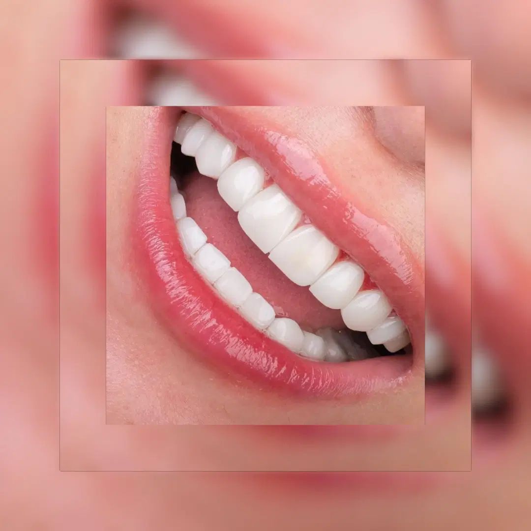 تخفیف 50 درصدی کامپوزیت و دندان پزشکی|خدمات آرایشگری و زیبایی|تهران, ایوانک|دیوار