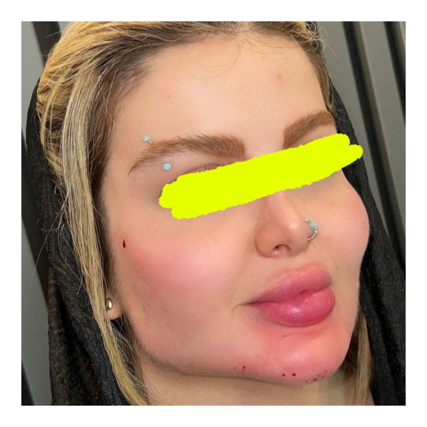 لب روسی پروفیس .جوانسازی.  پزشک|خدمات آرایشگری و زیبایی|اهواز, زیتون کارمندی|دیوار
