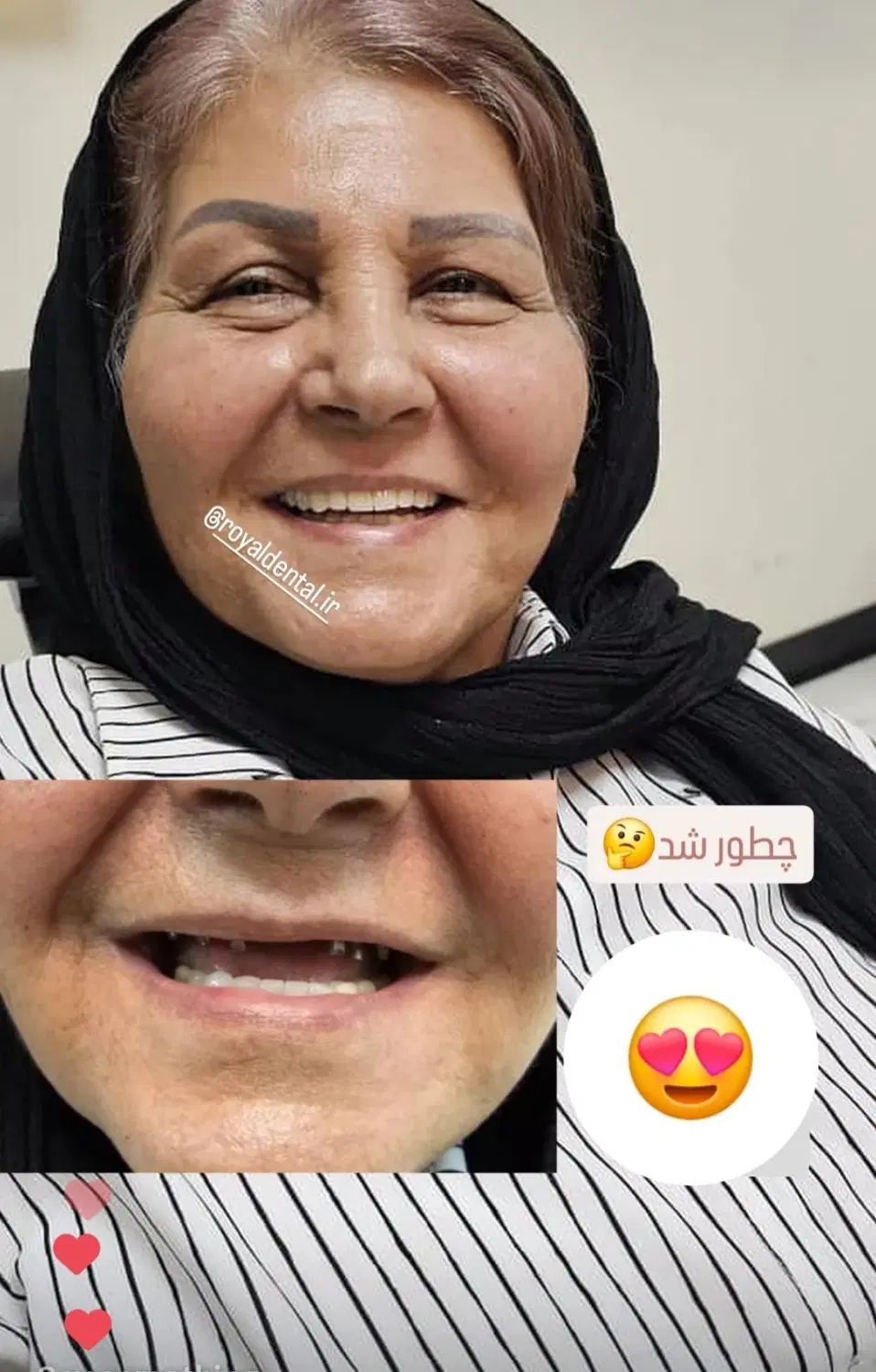 ایمپلنت کاشت دندان لمینت کامپوزیت ایمپلنت ۶۵۰۰|خدمات آرایشگری و زیبایی|تهران, ستارخان|دیوار