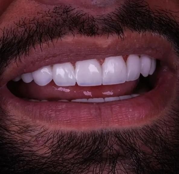 تخفیف های ویژه دندانپزشکی،کامپوزیت زیبایی،عصب کشی|خدمات آرایشگری و زیبایی|آبادان, |دیوار