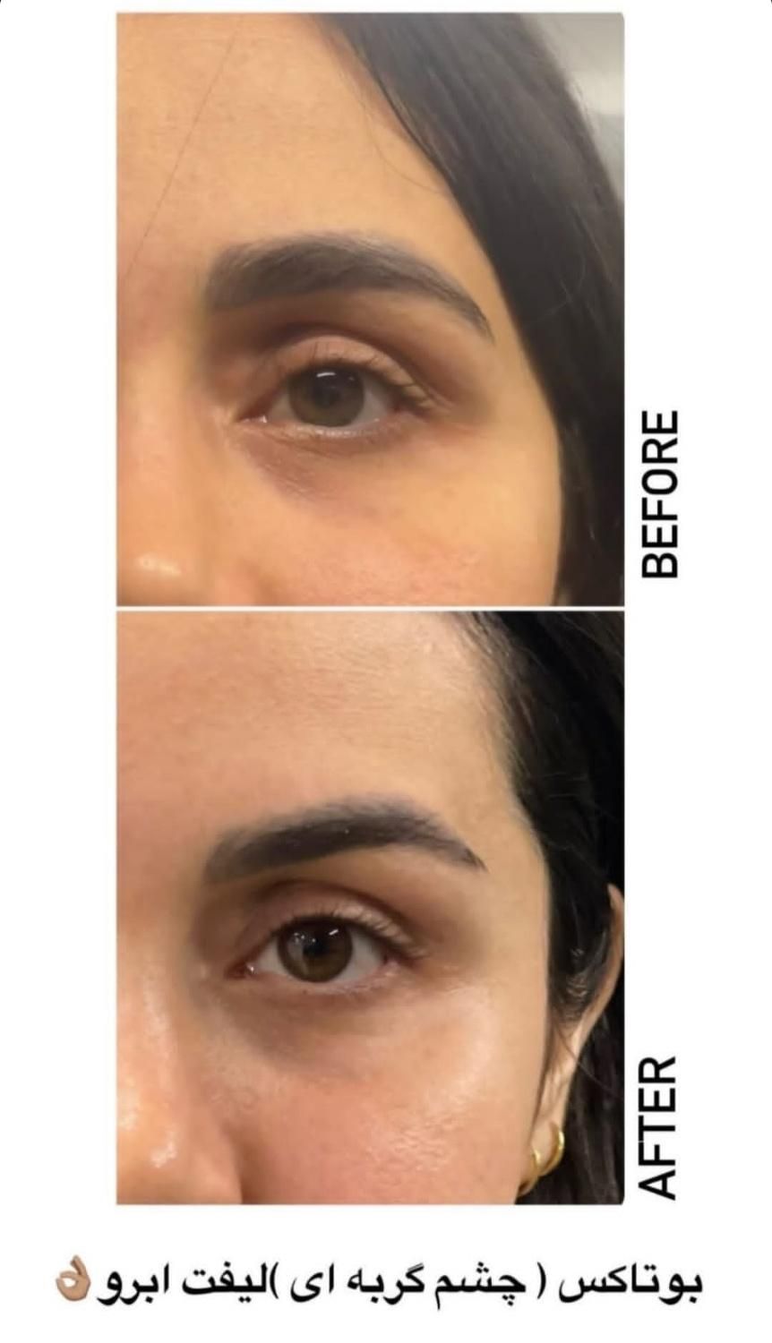 تزریق ژل و بوتاکس توسط پزشک|خدمات آرایشگری و زیبایی|بروجرد, |دیوار