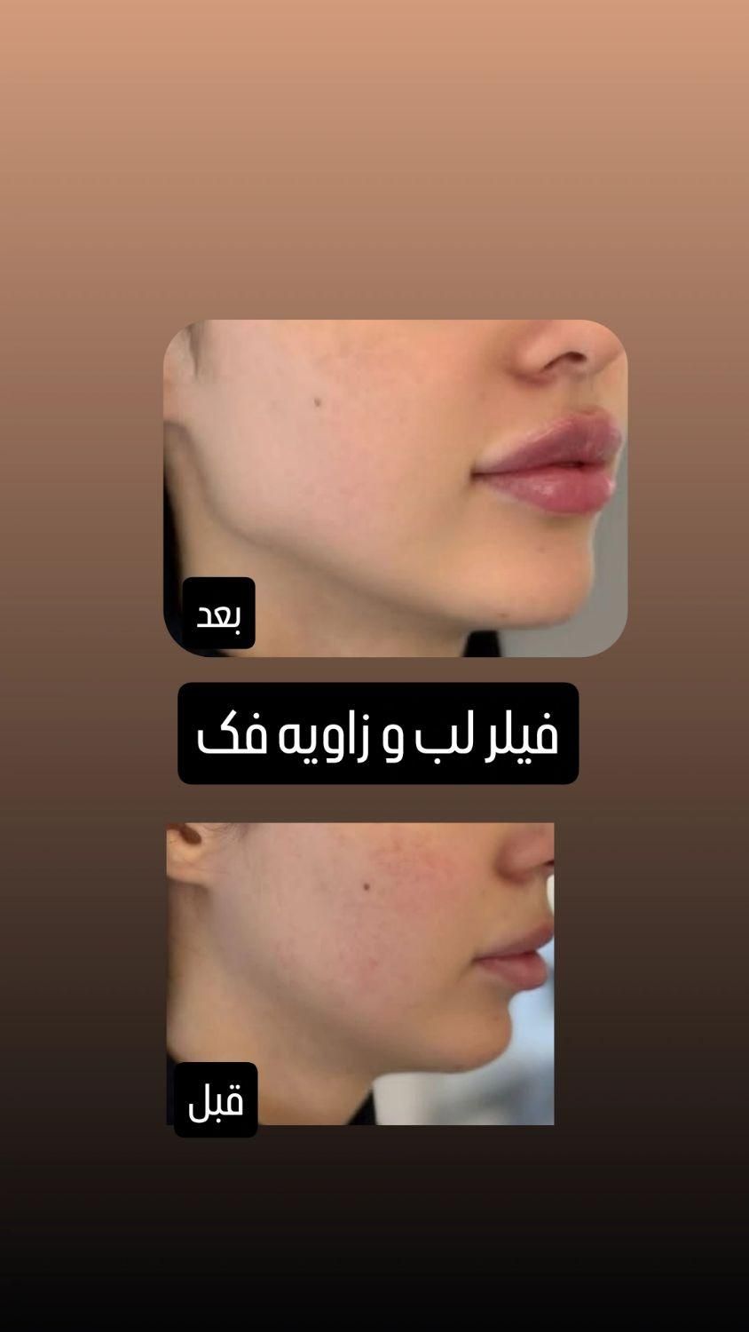 تزریق ژل وبوتاکس با بهترین قیمت در برازجان|خدمات آرایشگری و زیبایی|برازجان, |دیوار