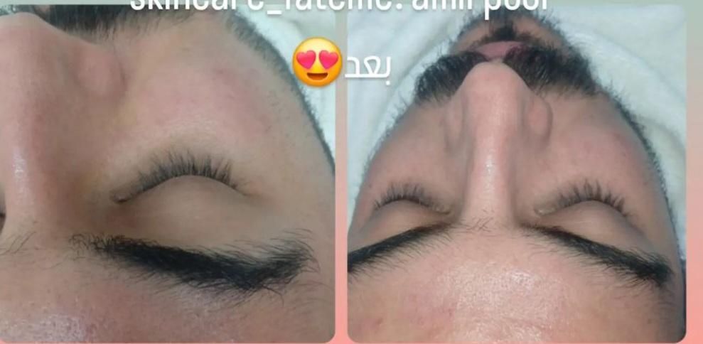 اموزش فیشال وکربوکسی و میکرونیدلینگ|خدمات آموزشی|یزد, |دیوار