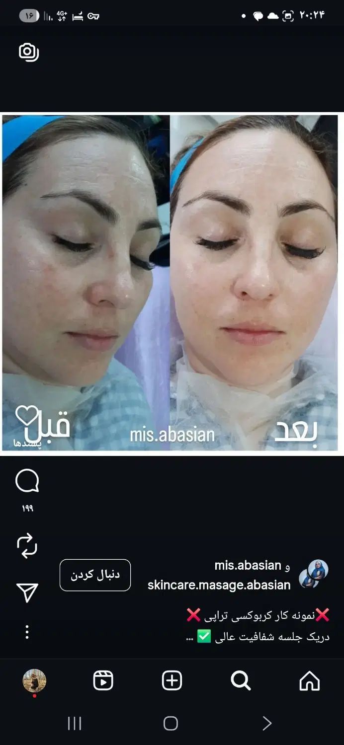 کربوکسی تراپی|خدمات آرایشگری و زیبایی|اصفهان, ناژوان|دیوار