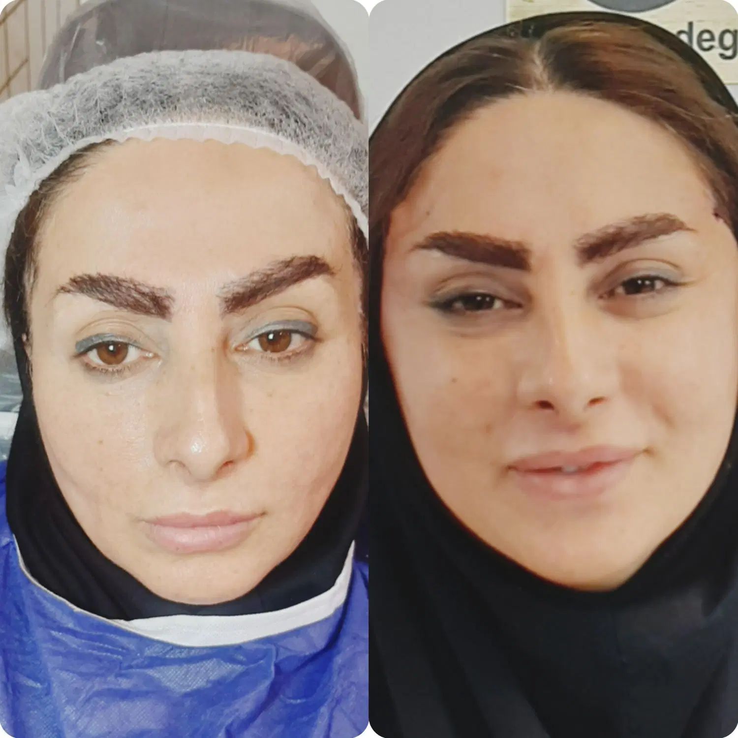 لیفت ابرو وشقیقه با جراحی ۸م .بوتاکس۶۰۰|خدمات آرایشگری و زیبایی|مشهد, شهید فرامرز عباسی|دیوار